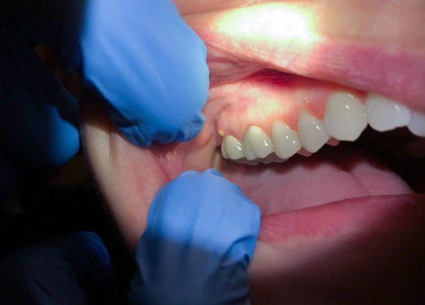 Best Emergency Tooth Extraction in Whittingham, NJ